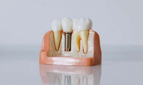 Implantología. Tratamientos y especialidades de la Clínica del Camino.