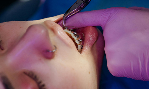 Ortodoncia. Tratamientos y especialidades de la Clínica del Camino.